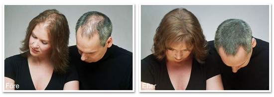 Toppik � f�re och efter