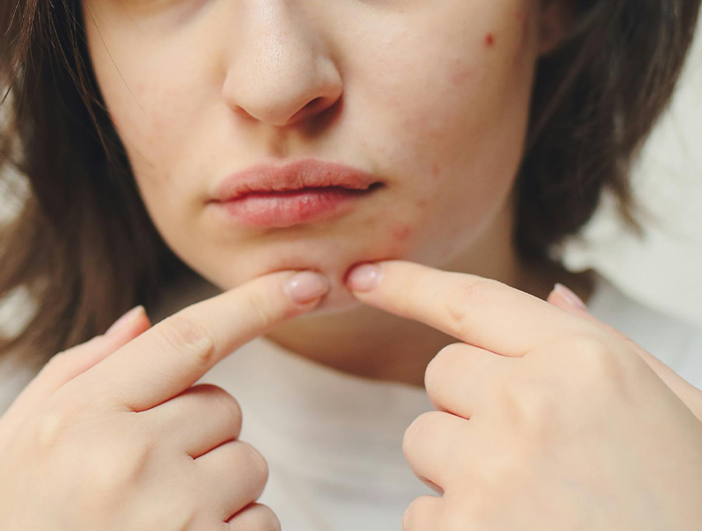 Allt du behöver veta om akne