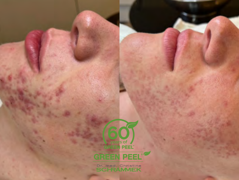Dr. Schrammek Green Peel - Före & efter