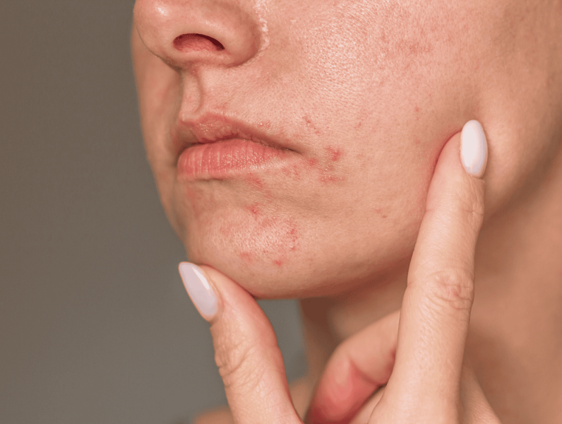Perioral Dermatit