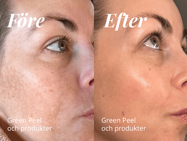 Sofies pigmentresa - så blir du av med pigmenteringar