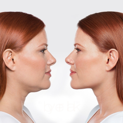 Injektionsbehandling Belkyra | Behandlingar - Ansikte - Injektionsbehandlingar | Apoteka