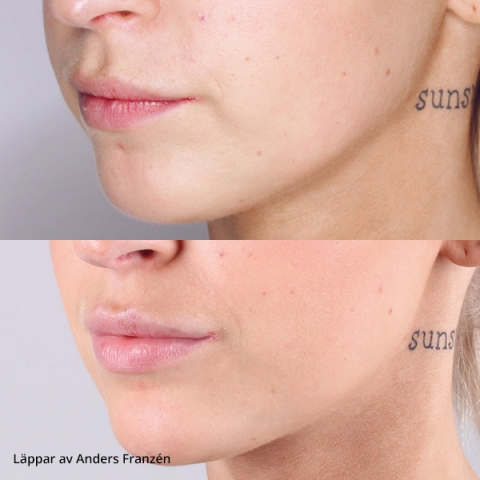 Injektionsbehandling Filler | Behandlingar - Ansikte - Injektionsbehandlingar | Apoteka