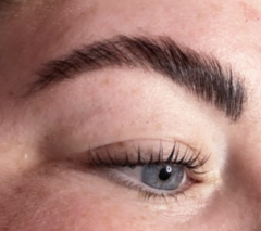 Brow Lift
