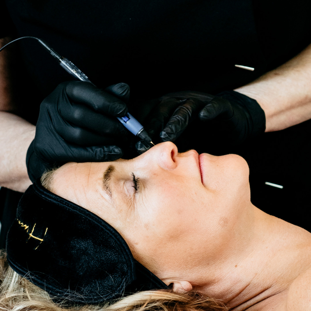 Epilering med Diatermi