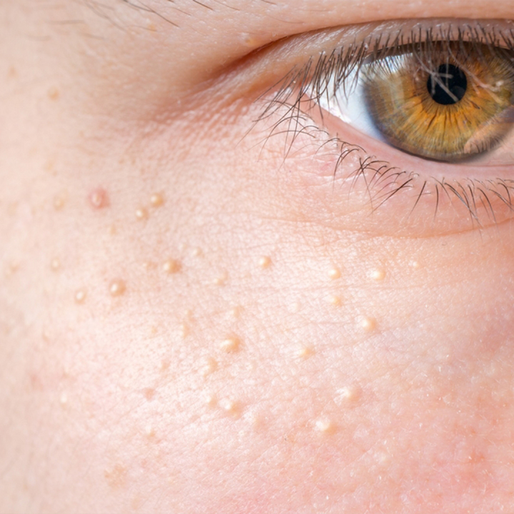 Borttagning av milier - enstaka | Behandlingar - Ansikte - Ansiktsbehandlingar - Klassisk hudvård | Apoteka