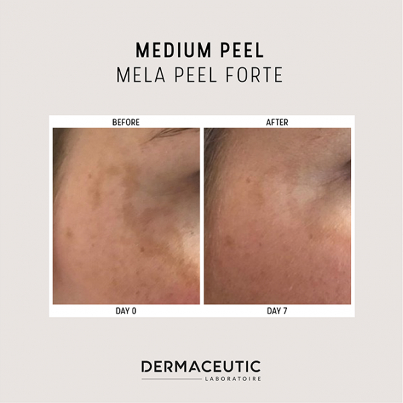 Ansiktsbehandling Dermaceutic Mela Peel Forte