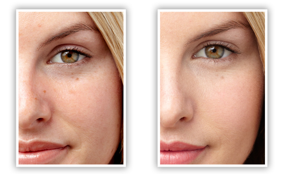 Concealer Före och efter Concealer Före och efter