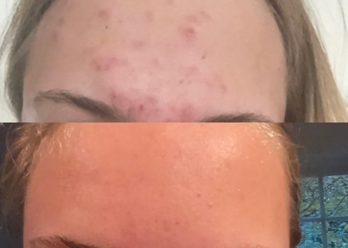 Före & Efter-bild på kund som med tre produkter behandlade sin akne.
