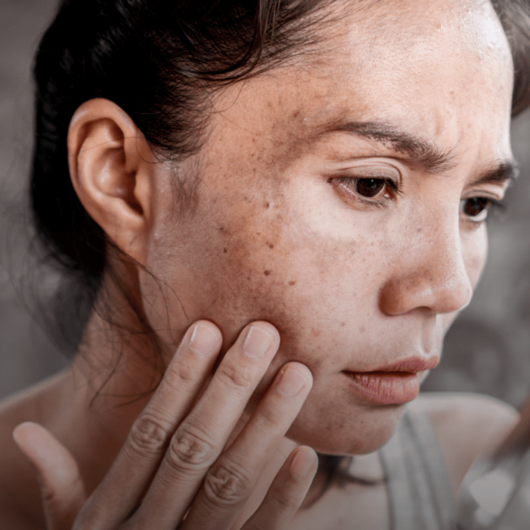 Beautypedia Hur förebygger jag pigmenteringar?