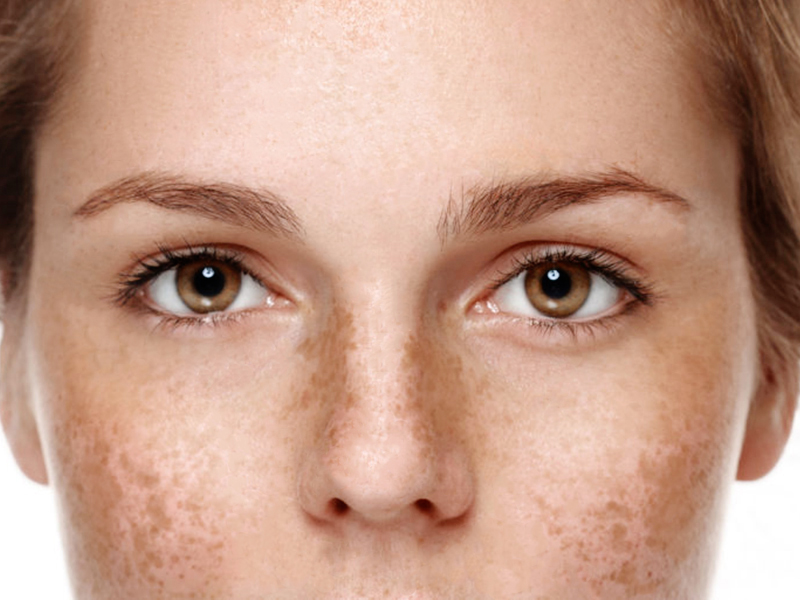 Hur blir jag av med pigmenteringar?