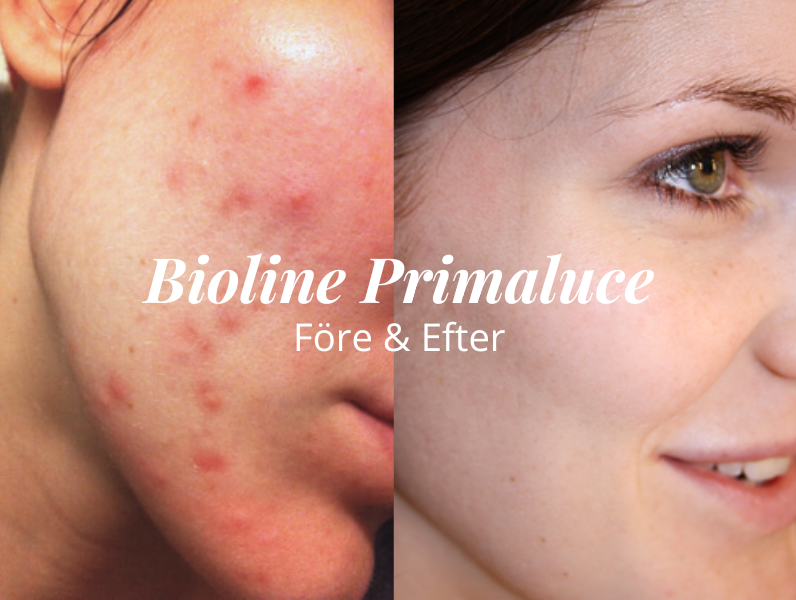 Före och efter Bioline Primaluce